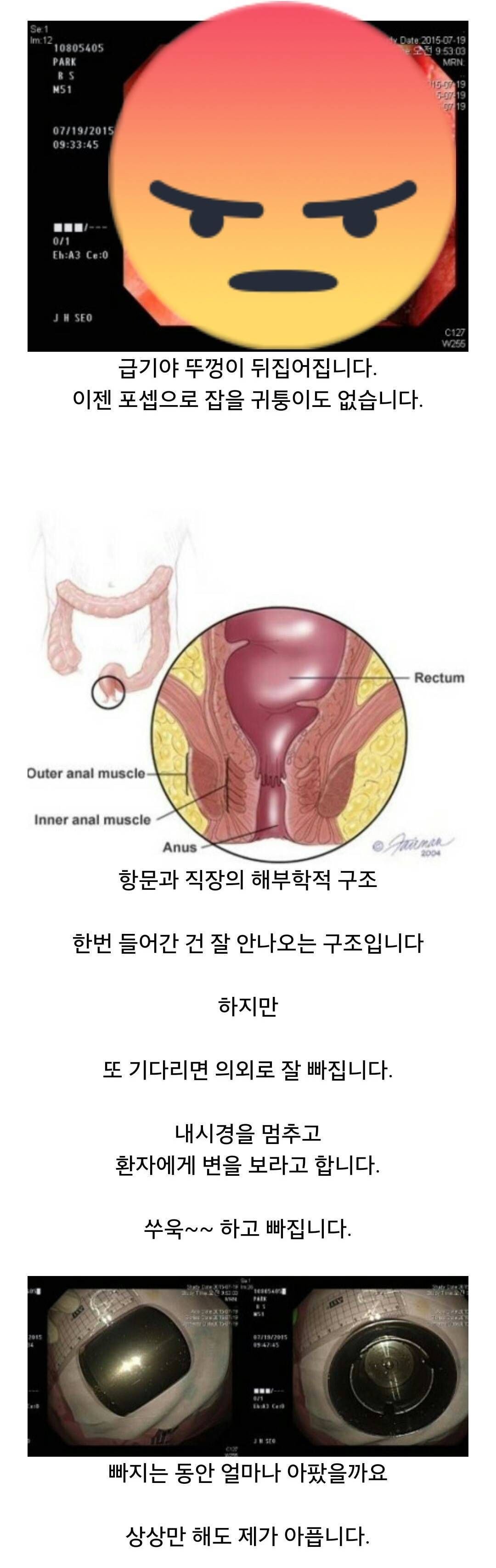X꼬에 자꾸 넣는 환자들을 보는 응급실 의사들. - 오픈이슈갤러리 - 인벤