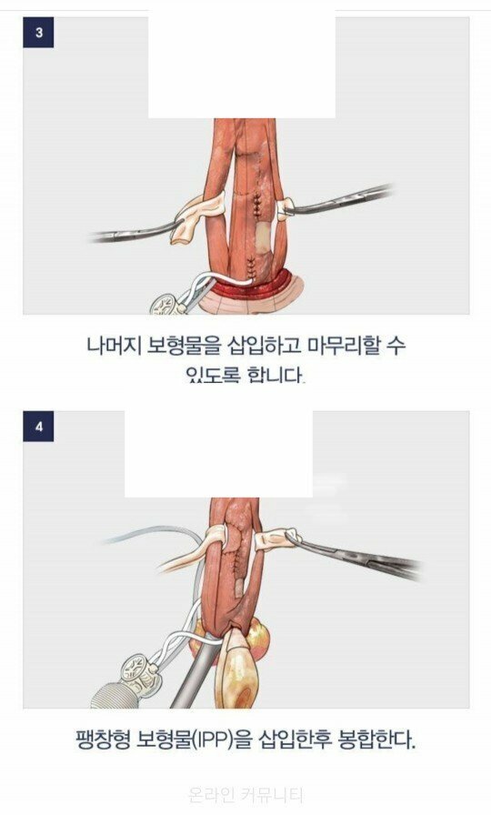 과연 쥬지의 길이는 수술로 늘릴 수 있는걸까?(그림 이미지 있음. 사람에 따라 혐일지도?) | 웹진 인벤 - 인벤