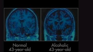 알콜중독자의 뇌 상태