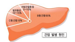 의외로 다들 모르는 간암의 주요 원인