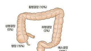 대장암 환자들의 공통된 생활 습관