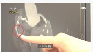 채식만 했는데도 심혈관질환이 온 스님