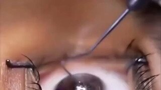 약혐 라식수술