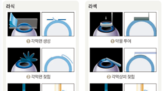 라식 라섹 차이