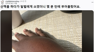 산책하다가 말벌에 쏘인 사람